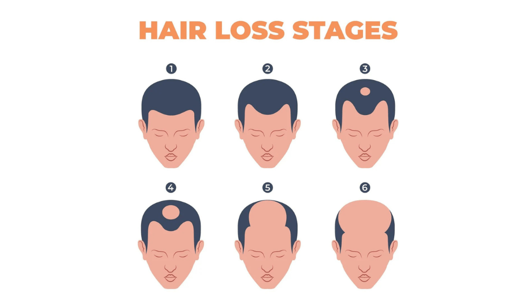 Hair Transplant